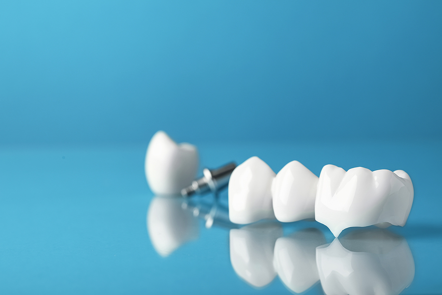 Restoring Your Smile with Crowns & Bridges in Royal Oak, MI