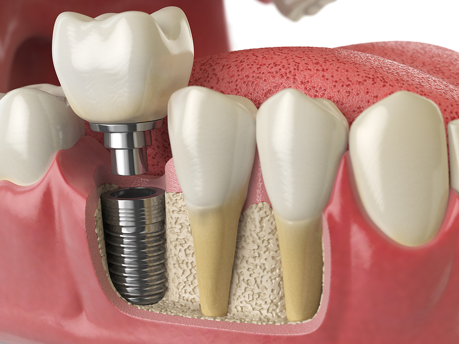 Dental Implants: The Permanent Solution for a Confident Smile