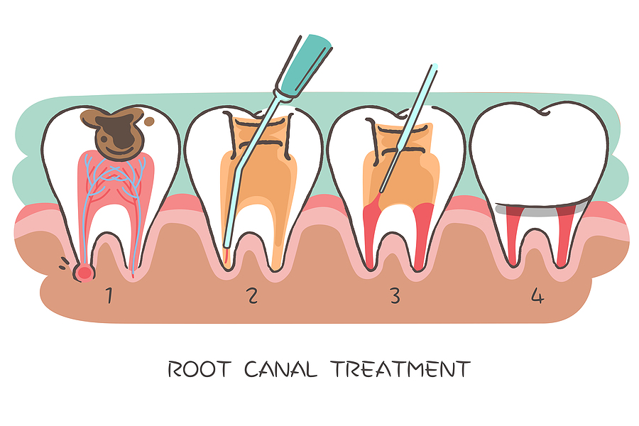 The Complete Guide to Root Canal Therapy: Save Your Natural Teeth with Expert Care