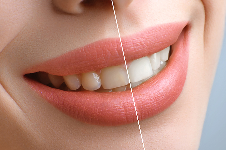 Brighten Your Smile: The Benefits of Professional Teeth Whitening